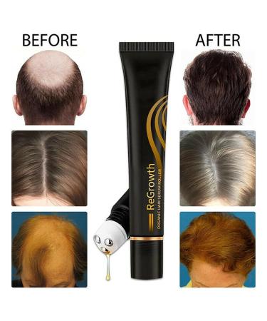 20ml Organic Hair Regrowth Serum Roller Set | Herbal Scalp Intense Roll-On for Men & Women | Triple Massager Hair Growth Essence (3PCs) - Buy Online on SooperMarket.com