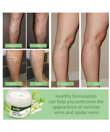 Purvigor Varicose Vein Cream - Eliminate Spider Veins & Phlebitis Angiitis on Leg, Body & Arms - Buy Online on SooperMarket.com