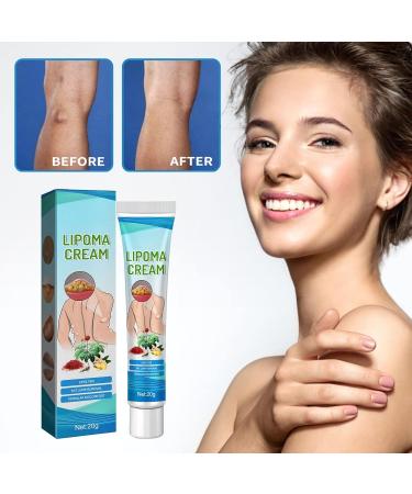 Lump-Free Lipoma Removal Ointment - Natural Vegetable Formula for Anti-Swelling & Skin Care - Hyper Havoc (White, One Size) - Buy Online on SooperMarket.com