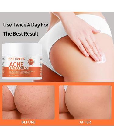 Salicylic Acid Acne Treatment Cream for Face & Body - Teens & Adults | Anti-Acne Moisturizer & Spot Treatment - Buy Online on SooperMarket.com