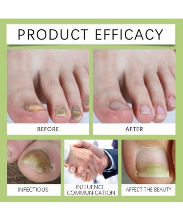 Nail Nourishing Solution | Multifunctional Nail Repair Drops | Nail Strengthening Drops | Hydrating Nail | Natural Nail Repair Remedy |-Infused Nail - Buy Online on SooperMarket.com