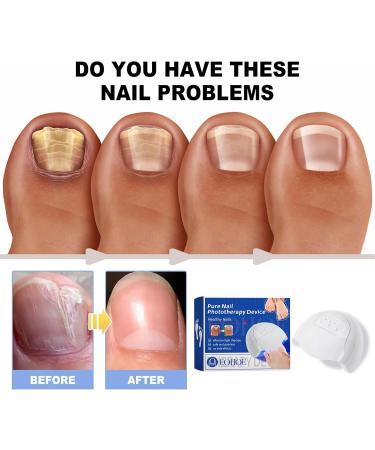 SenhE Fungus Laser Therapy Device Antibacterial Laser Equipment Light Therapy Device Fungal Nail Revolutionary High-Efficiency Light Therapy Device for Toenail Diseases  - Buy Online on SooperMarket.com