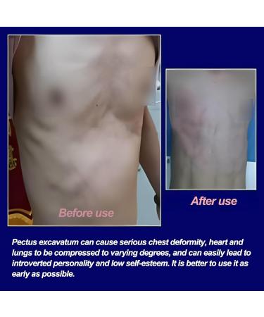 Pectus Excavatum Orthosis Brace-Vacuum Bell Pectus Excavatum-Sternal Depression Support-for All Ages(L) - Buy Online on SooperMarket.com