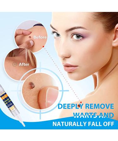 Extra Strength Skin Tag Remover | Wart Removal | Tag Dries and Falls Away | Natural Ingredients | All Skin Types - Buy Online on SooperMarket.com