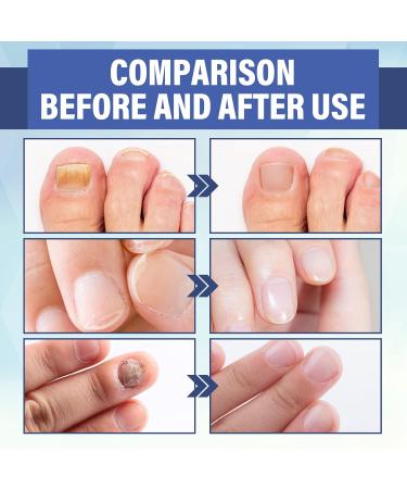 NailPro Nail Fungus LED Light Therapy Device Nail Fungus Laser Nail Fungus Treatment Home Use Nail-Fungus Remover for Toenail Fingernails & Onychomycosis (A01) - Buy Online on SooperMarket.com