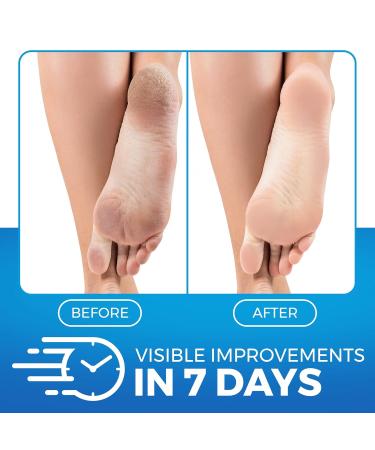 Imperial Feet Urea Foot Balm - Natural Moisturizing Cream for Rough Skin & Cracked Heels - 150ml Antioxidant Formula with Wild Herb Extract - Buy Online on SooperMarket.com