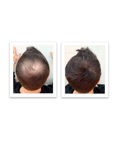 Dark Brown Hair Loss Concealer Trial Size - Cover Bald Spots Instantly - 10-Day Supply - All-Natural Fiber Formula - Buy Online on SooperMarket.com