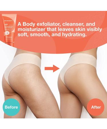 KP Bump Eraser Body Scrub - Exfoliating Strawberry Legs Treatment for Women & Men - 8.45oz - Buy Online on SooperMarket.com