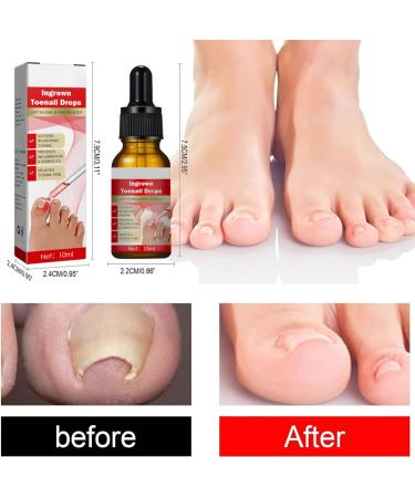 Ingrown Toenail Treatment Nail Growth Ingrowing Toenail Treatment Nail Helper Fungal Nail Treatment Correction Oil Drops Ingrown Toenail Corrector Toe Nail Fungus Treatment Cuticle Oil - Buy Online on SooperMarket.com