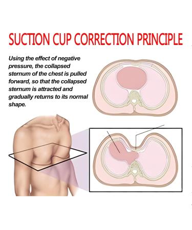 Pectus Excavatum Orthosis Brace-Vacuum Bell Pectus Excavatum-Sternal Depression Support-for All Ages(L) - Buy Online on SooperMarket.com