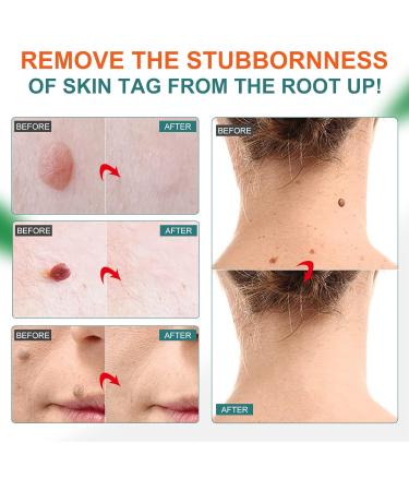 Skin-Tag-Remover Kit Remover for Verruca-Treatment - 30ml - Buy Online on SooperMarket.com