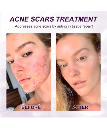 Marianp Hyaluronic Acid Serum & Azelaic Acid 10% for Acne Pigmentation & Rosacea - Vitamin B3 & B5 | Best Skincare Treatment - Buy Online on SooperMarket.com