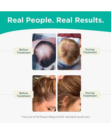 Vegan Hair Loss Shampoo and Conditioner Set | Dermatologist Developed DHT Fighting Treatment for Thinning Hair | Healthier, Fuller, Thicker Hair | 1-Month Supply - Buy Online on SooperMarket.com