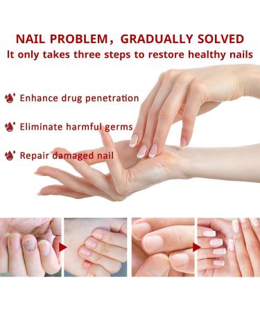 TBeautfave Fungal Nail Treatment Antifungal Nail Treatment Toe Nail Fungal Treatment Fungal Nail Treatment for Toenails Extra Strong Nail Repair and Strengthen Fix & Renew Damaged Broken Nails - Buy Online on SooperMarket.com