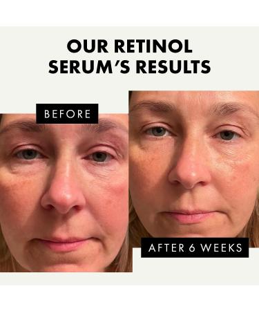 Retinol Serum for Face - 2.5% Pure Anti-Wrinkle Serum with Hyaluronic Acid & Vitamin B3 | Resurfacing Anti-Aging Treatment for Men & Women - Facial Acne Solution - Buy Online on SooperMarket.com