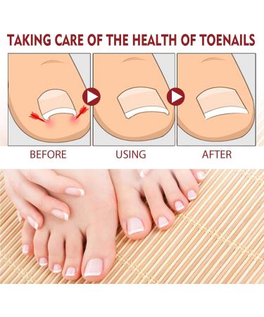 Ingrown Toenail Treatment and Removal Relief Oil - Nail Growth and Fungal Corrector - Buy Online on SooperMarket.com