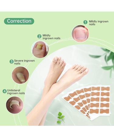 Ingrown Toenail Treatment Kit - 50 Pcs Patches, Corrector Strips, Nail Lifter | Professional & Painless Solution - Buy Online on SooperMarket.com