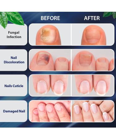 Extra Strength Toe Fungus Nail Treatment - Anti Fungal Care for Toenails & Fingernails - Buy Online on SooperMarket.com
