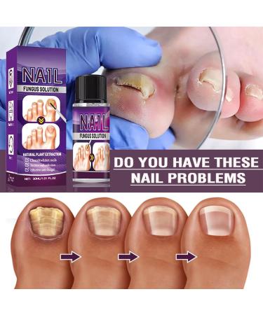 Fungal Nail Treatment 30ml Extra Strong Nail Fungus Treatment for Toenail and Fingernail Premium Fungal Nail Eliminator Anti fungus Nail Repair and Strengthen Fix & Renew Damaged Broken Nails - Buy Online on SooperMarket.com