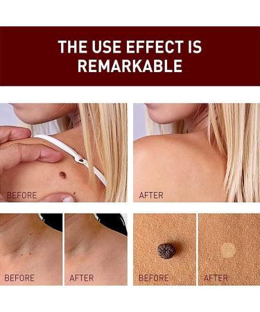 Wipeoff Tags & Moles Remover - Fast & Effective - 2PCS Set - Remove in 5 Days - Safe for All Body Parts - Buy Online on SooperMarket.com