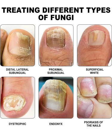 SenhE Fungus Laser Therapy Device Antibacterial Laser Equipment Light Therapy Device Fungal Nail Revolutionary High-Efficiency Light Therapy Device for Toenail Diseases  - Buy Online on SooperMarket.com