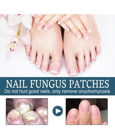 Fungal Nail Treatment - Extra Strong Nail Fungus Treatment for Toenail and Fingernail - Fungal Nail Eliminator Anti fungus Nail Repair and Strengthen Fix & Renew Damaged Broken Nails 30ml - Buy Online on SooperMarket.com