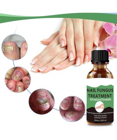 Nail Fungus Treatment For Toenail - Extra Strong Fungal Nail Treatment - Anti fungus Nail Repair and Strengthen Fix & Renew Damaged Broken Nails (2PC) - Buy Online on SooperMarket.com