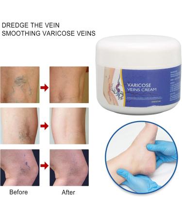 50g Natural Varicose Veins Cream | Leg Circulation & Spider Vein Remover | Cooling Effect | Ointment - Buy Online on SooperMarket.com