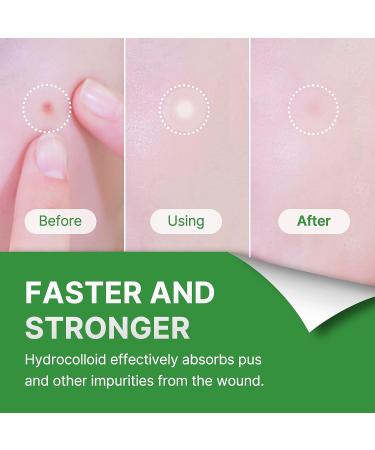 Invisible Pimple Spot Patch - Signature Hydrocolloid Acne Patches for Face | 96 Count | Overnight Pimple Patches - 2 Sizes - Buy Online on SooperMarket.com