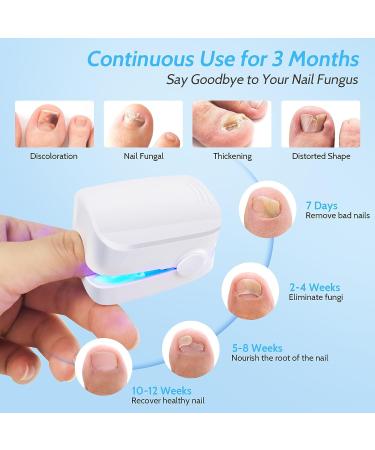 Incley Nail Fungus Cleaning Laser Device - Effective Blue Light Therapy for Toenails & Onychomycosis - Rechargeable Fungus Remover for Home Use - Buy Online on SooperMarket.com
