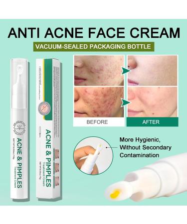 Anti-Acne Face Cream Spot Cream for Acne Treatment and Spot Treatment Skin Treatment Gel Cream For Face Blemishes & Blackheads Acne Treatment Cream Anti Acne Spot - Buy Online on SooperMarket.com