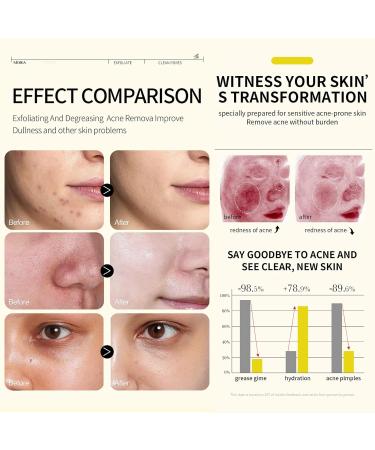 Skincare Set for Acne Prone Skin Anti Acne Skin Care Sets & Kits Skincare Gift Set with Cleanser- Serum- Essence Gel- Mask*2 Acne Remove Oil Control Facial Kit Hydrate Shrink Pore Sooth Redness - Buy Online on SooperMarket.com