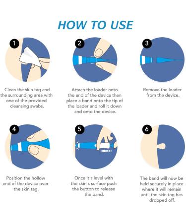 Skin Tag Remover Kit with Auto Pen, 40 Bands - Painless Device for Small to Large Warts (2mm-8mm) - Buy Online on SooperMarket.com