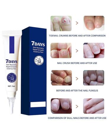 7 Days Nail Recovery & Growth Essence Pen - Strengthening Serum for Thin Nails (2PCs) - Buy Online on SooperMarket.com