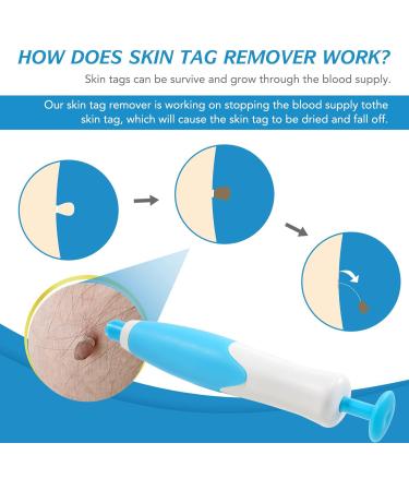 Skin Tag Remover Kit with Auto Pen, 40 Bands - Painless Device for Small to Large Warts (2mm-8mm) - Buy Online on SooperMarket.com