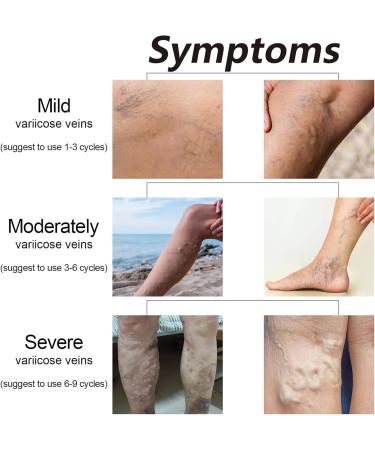 Marronie Oil for Varicose Veins Marronie Chamomile Essential Oil for Varicose Veins 1/3/5 Pack Marronie Oil Varicose Veins (3pcs) - Buy Online on SooperMarket.com