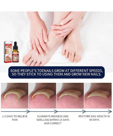 Ingrown Toenail Treatment Nail Growth Ingrowing Toenail Treatment Nail Helper Fungal Nail Treatment Correction Oil Drops Ingrown Toenail Corrector Toe Nail Fungus Treatment Cuticle Oil - Buy Online on SooperMarket.com