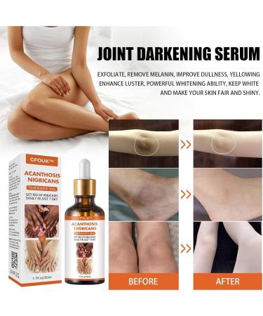 Skin Bleaching Serums | Dark Skin Permanent Whitening Lightening | Armpit Bleaching Serums for Women Supercharged Face Serums Skin Lightening Bleaching Oil Black Spot Corrector Remover for Face 2Pcs - Buy Online on SooperMarket.com