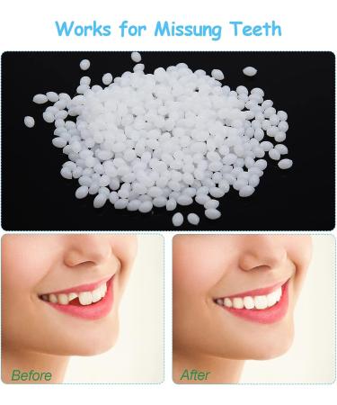 CAILING Snap On Veneers for Missing Teeth - 6 Sets Instant Denture Filling Kit - Fake Braces for Realistic Looking Teeth - Buy Online on SooperMarket.com