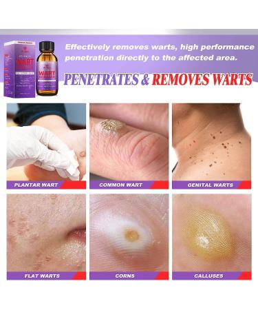 Dr. DERM Maximum Strength Wart Remover Liquid Gel - Fast-Acting Treatment for Plantar, Genital, Corn, Common, and Flat Warts - Natural and Safe Formula - 0.5 Fl Oz - Buy Online on SooperMarket.com