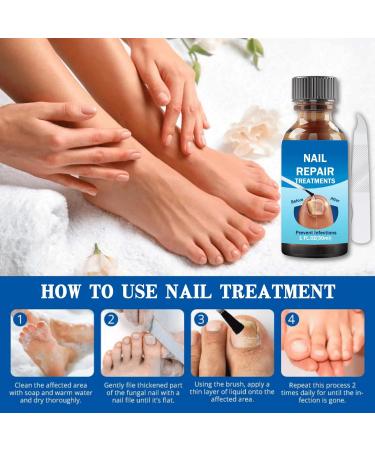 Fungal Nail Treatment 30ML Nail Fungus Serum for Toenail Extra Strong Gentle Anti Fungal Nail Serum Protects Thick Broken Discolored Nails Restoring Healthy Nails For Finger And Toe Nail Fungal - Buy Online on SooperMarket.com