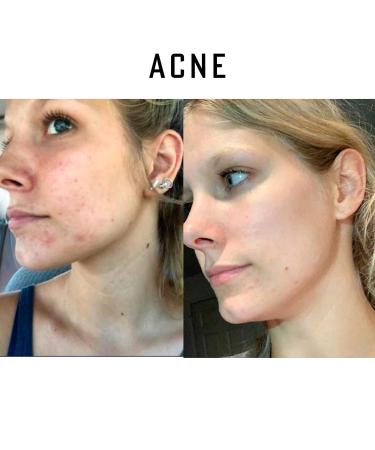 Buy Pure Organic Ozonated Olive Oil Extra Strength 1200 - Acne Anti-Aging Rosacea Treatment for Sensitive Skin - Made in Spain - Buy Online on SooperMarket.com