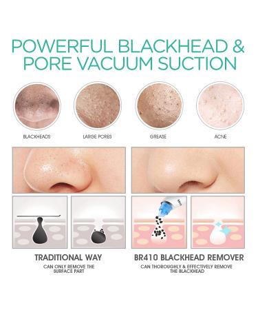 VOYOR Blackhead Remover Pore Vacuum - Electric Face Cleaner with 6 Suction Heads for Acne and Whitehead Removal - Buy Online on SooperMarket.com
