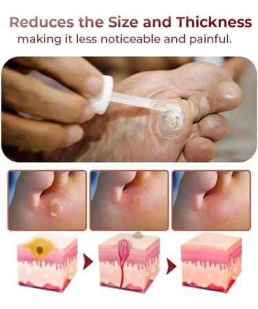 Xebular Foot Corn Removal Gel - Extra Strength Liquid for Toes - Callus & Corn Remover (3 PCS) - Buy Online on SooperMarket.com