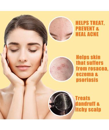 10% Sulfur Soap Cleansing Bar for Acne, Oily Skin - Natural Face & Body Cleanser with Lemongrass, Tea Tree Oil, Vitamin E - 2 Pack USA Made - Buy Online on SooperMarket.com