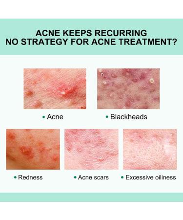 Anti-Acne Face Cream Spot Cream for Acne Treatment and Spot Treatment Skin Treatment Gel Cream For Face Blemishes & Blackheads Acne Treatment Cream Anti Acne Spot - Buy Online on SooperMarket.com