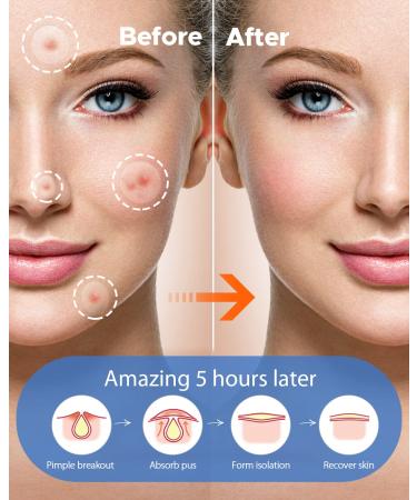 LitBear Acne Pimple Patches - Day and Night Set | 180 Dots with Witch Hazel, Tea Tree & Calendula Oil | Extra Adhesion for Face | Zit Patch AM + PM - Buy Online on SooperMarket.com
