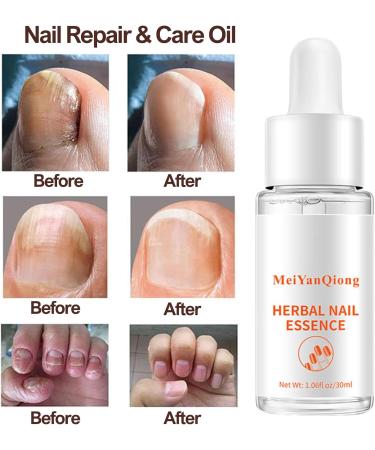 Organic Cuticle Nail Oil 30ml Vitamin B & E Essential Oil Moisturize with Convinient Dropper Design Nail Cuticles Oils Treatment Damaged Dry for Nail Care Repair Growth (Herbal) - Buy Online on SooperMarket.com