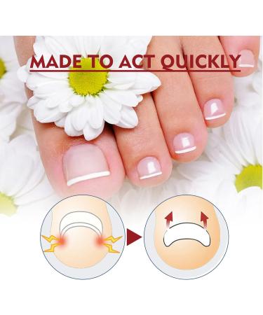 Toenailplus Anti Paronychia Relief Oil - 10ml 2pcs - Nail Helper for Ingrowth Toenail Correction & Paronychia Treatment - Buy Online on SooperMarket.com