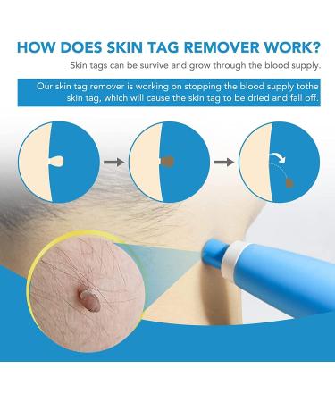 OakRidge Products Skin Tag Remover Painless Pen Removal Kit Tools with 40 Micro and Regular Bands Easy Device to Remove(1mm-8mm) Tags (2in1 Kit) (2-8mm) Blue Number Of Items: 1 1.0 count - Buy Online on SooperMarket.com